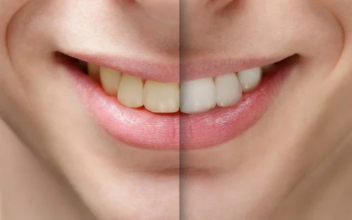 before after whitening